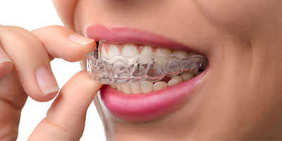 Invisalign Trenton MI